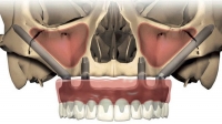 Скуловая имплантация Zygoma